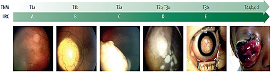 IIRC與TNM分期對應表