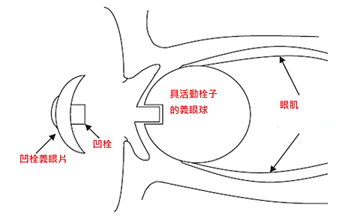 義眼球植入後示意圖.png