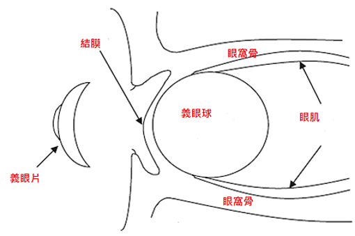義眼球植入後示意圖1